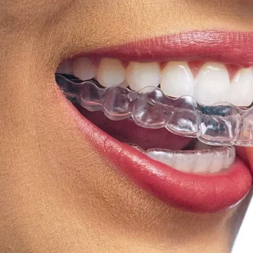 invisalign