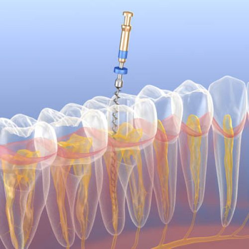 Endodontic root canal treatment process. Medically accurate tooth 3D illustration.